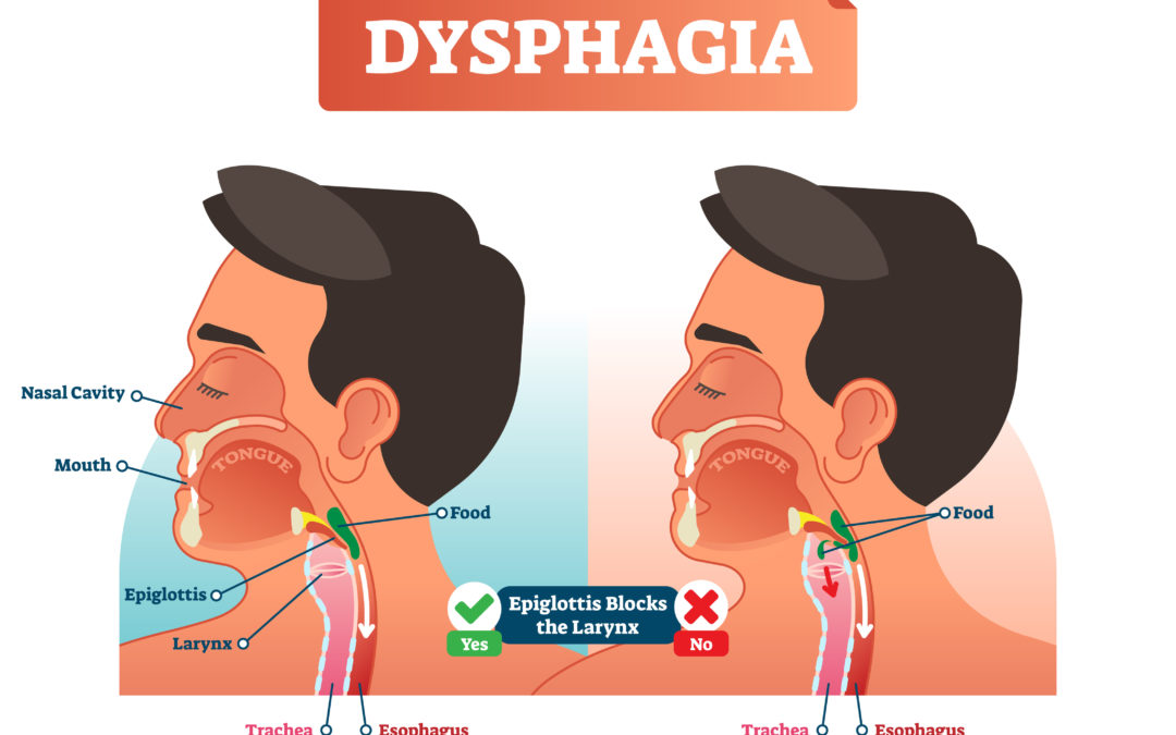 Swallowing and Strengthening Exercises for Dysphagia